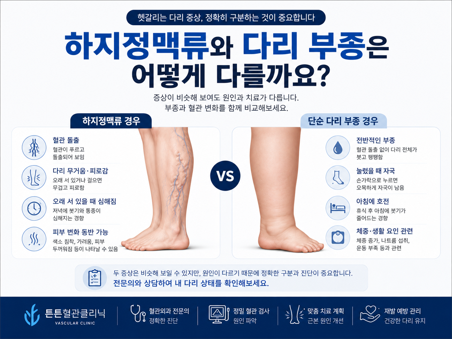 하지정맥류와 다리 부종은 어떻게 다를까요?