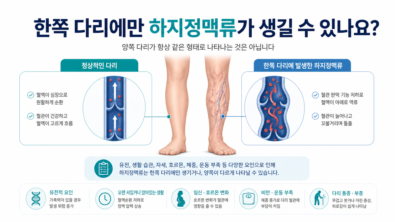 한쪽 다리에만 하지정맥류가 생길 수 있나요?